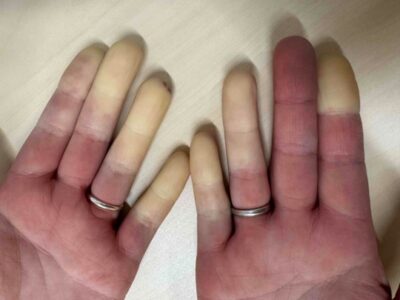 レイノー現象は膠原病に合併しやすいのアイキャッチ画像